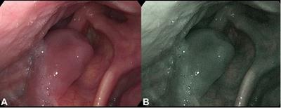 Case report: An uncommon presentation of extramedullary plasmacytoma without a concurrent diagnosis of multiple myeloma